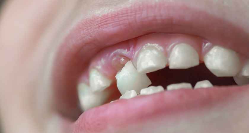 Sonhar com dente caindo no mundo espiritual e seu significado bíblico segundo a interpretação cristã dos sonhos.